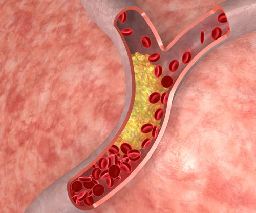 cholestrol-in-artery