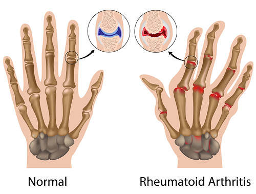 rheumatoid-arthtitis-hand